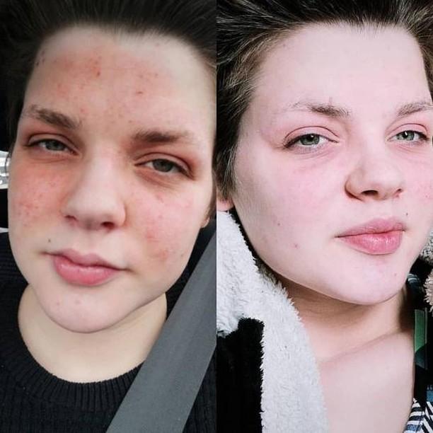 DeepMarine marine collagen heals eczema