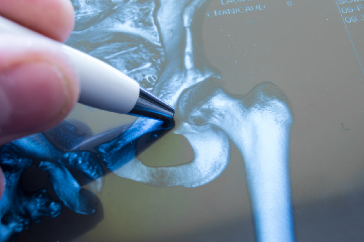 Hip Pain: How Do You Know When It’s Time for a Hip Replacement?