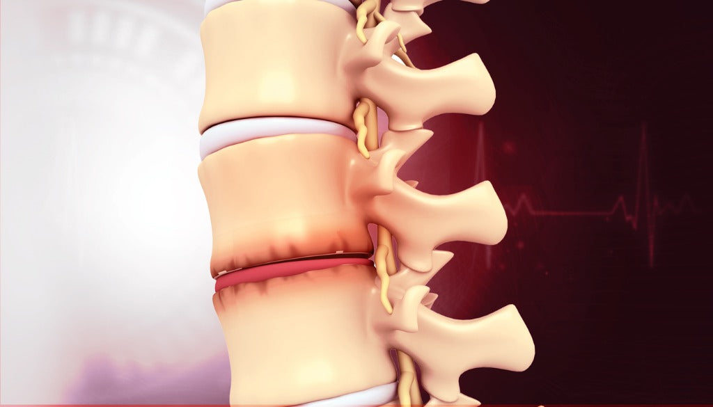 back pain caused by degenerative disc disease